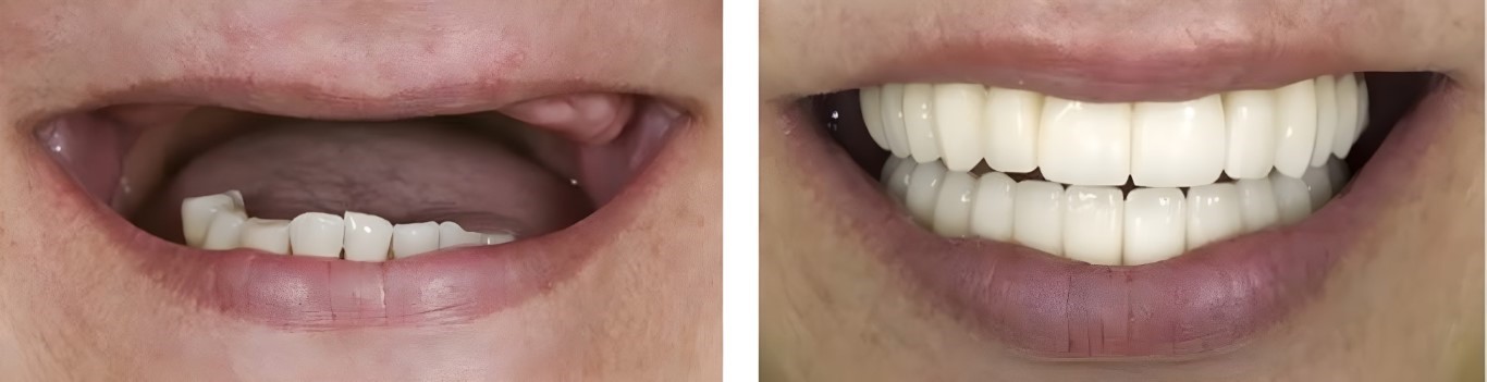 protese dentaria antes e depois (1)