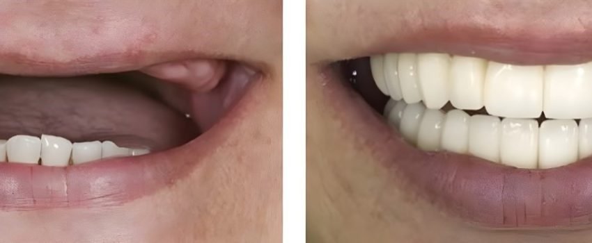 protese dentaria antes e depois (1)